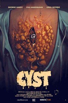 Cyst